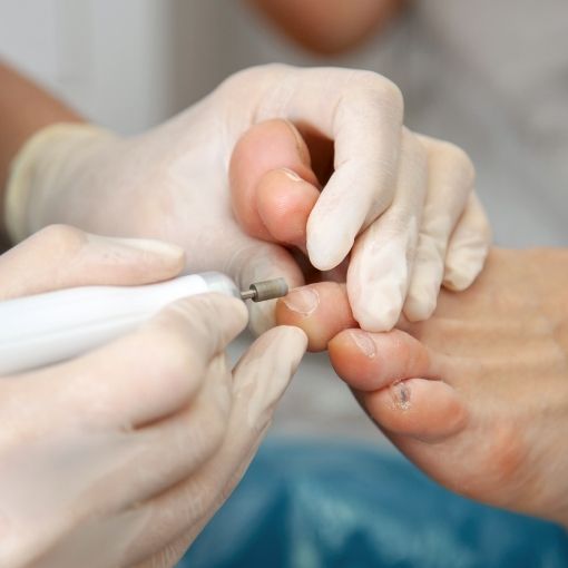 podiatry treatment on toenails using an electric nail file on a patient’s foot with visible toenail and skin issues.