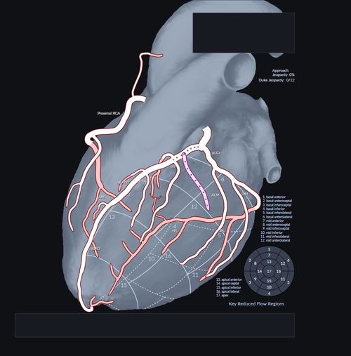 CARAT diagram showcasing the ability to paint unique branches or grafts onto a patients coronary anatomy