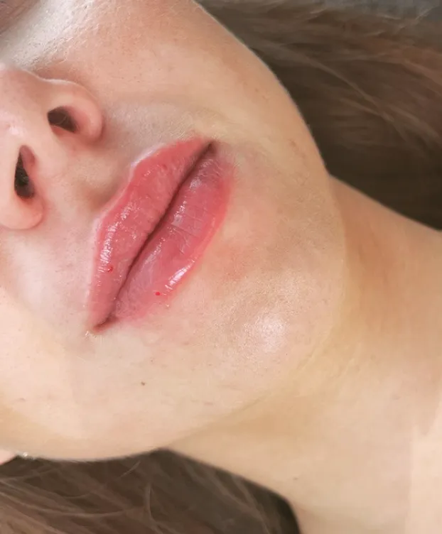 huulten täyttö helsinki – Jälkeen