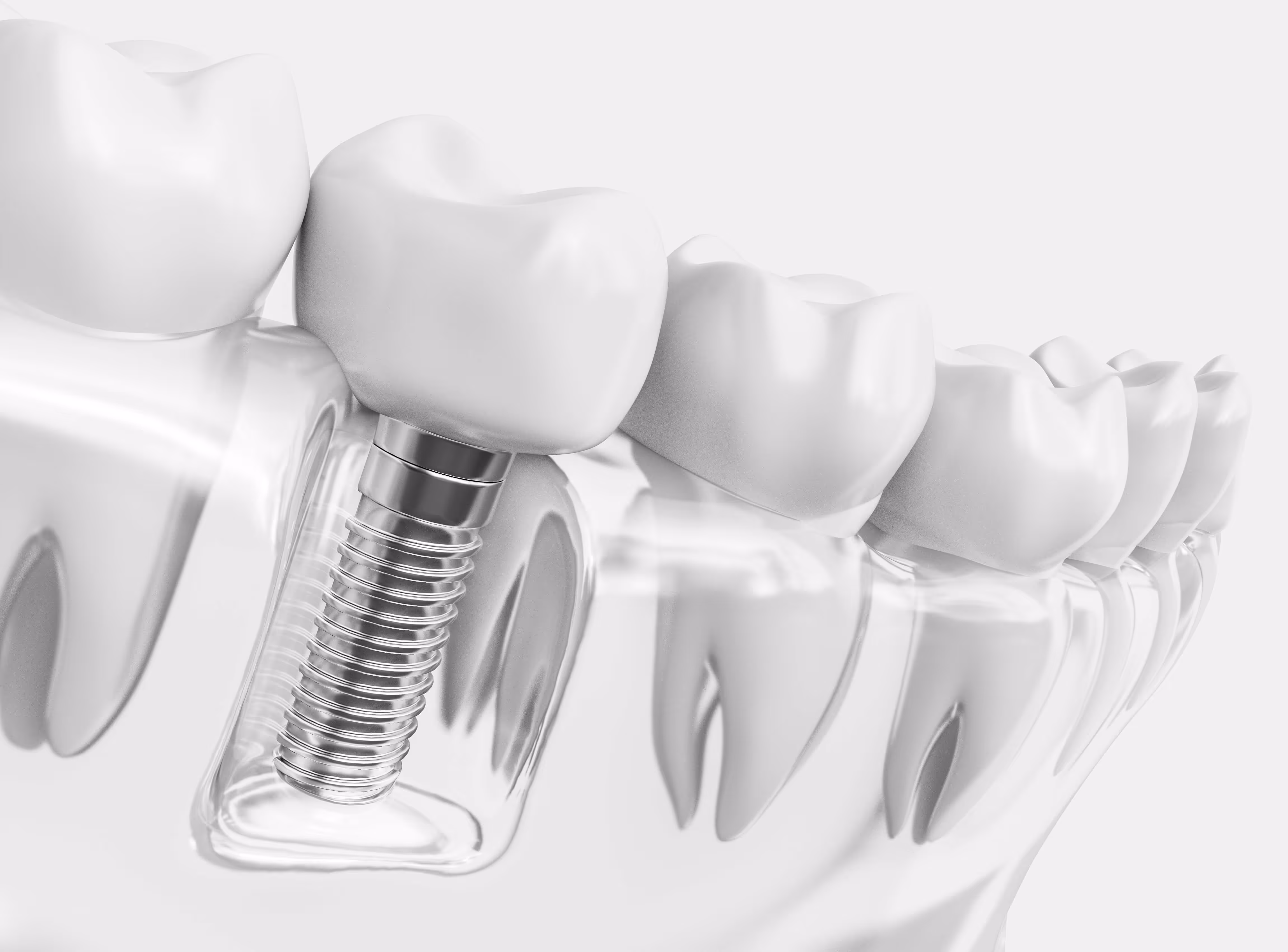 What are Single Tooth Implants?