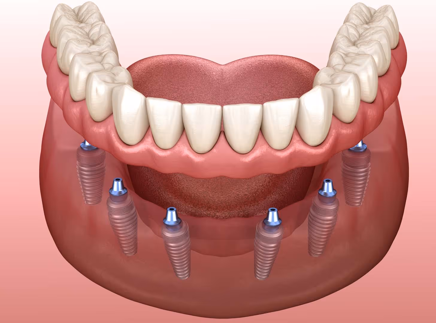 What are Implant Supported Dentures?