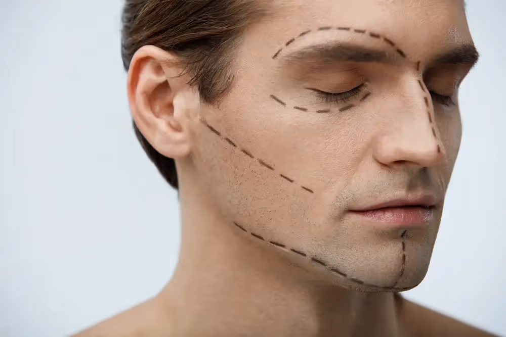 Facial Feminization Surgery