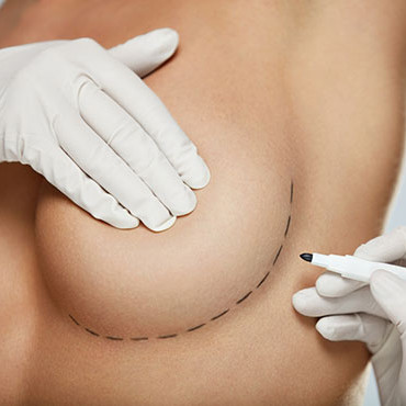 Surgeon making incision marks under breast with a marker, pre-surgery