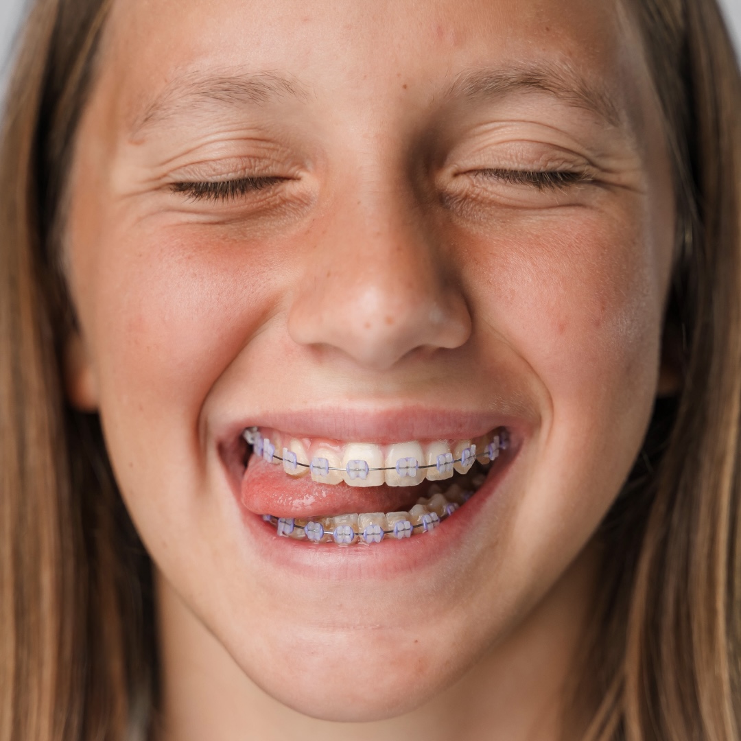 Ceramic Braces in Bryn Mawr | Bryn Mawr Orthodontics