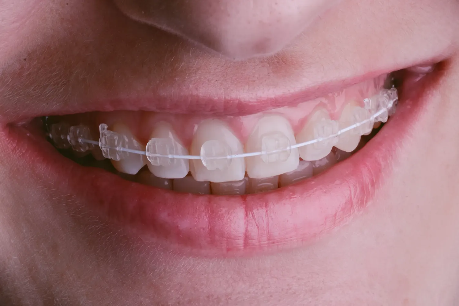 Ceramic Braces in Bryn Mawr | Bryn Mawr Orthodontics