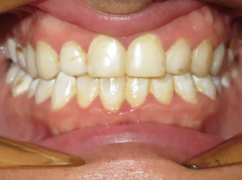 before and after treatment