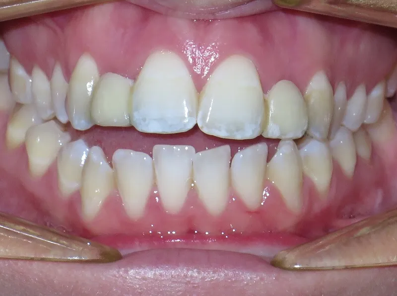 before and after treatment