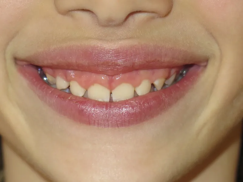 before and after treatment