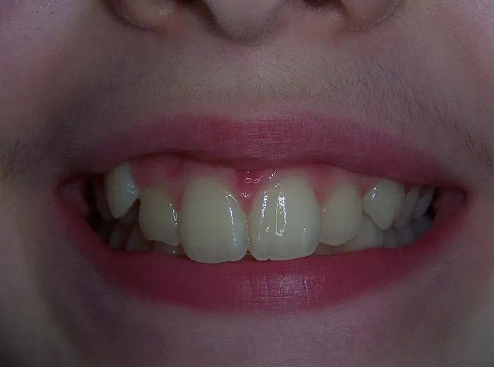 before and after treatment