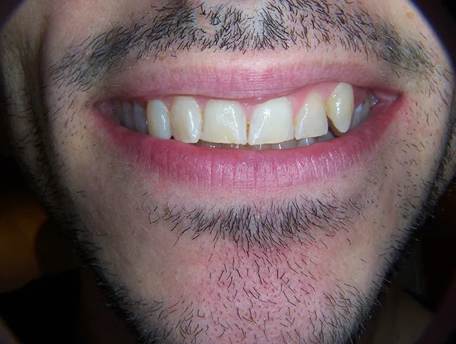 before and after treatment
