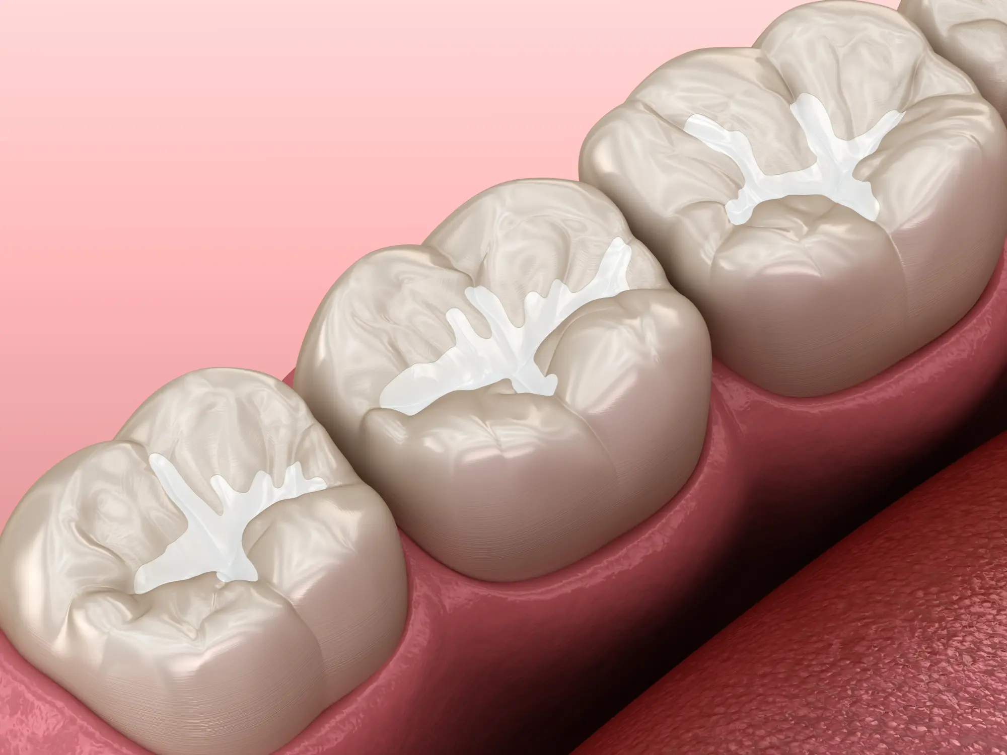 Are Dental Sealants Covered by Insurance? What Parents Should Ask