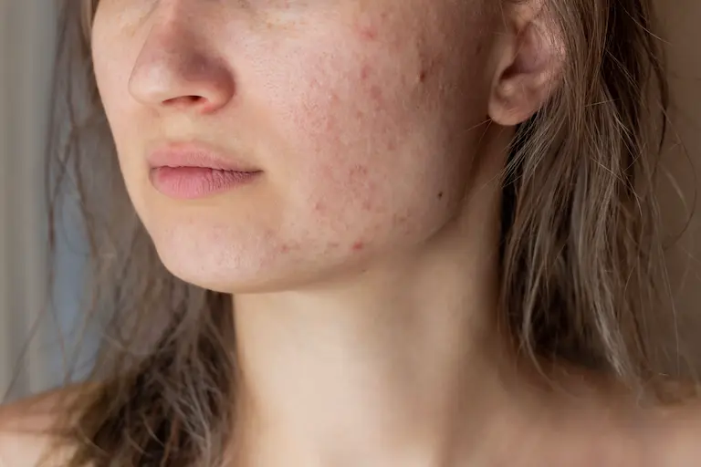 A woman's face showing acne on cheeks and chin.