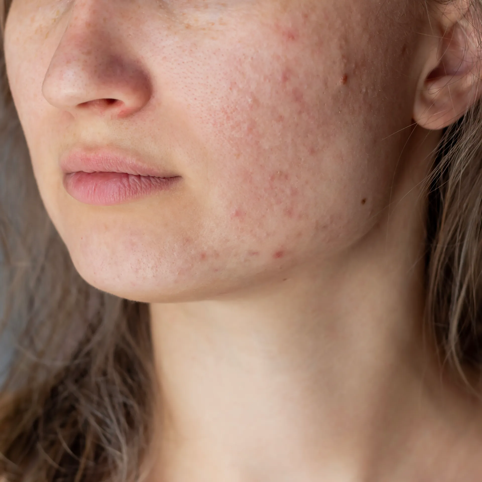 Close-up of adult skin with mild hormonal acne and natural redness along the jawline and cheeks