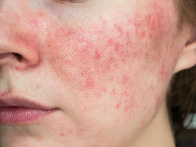Facial skin showing redness and sensitivity, often associated with skin barrier disruption.