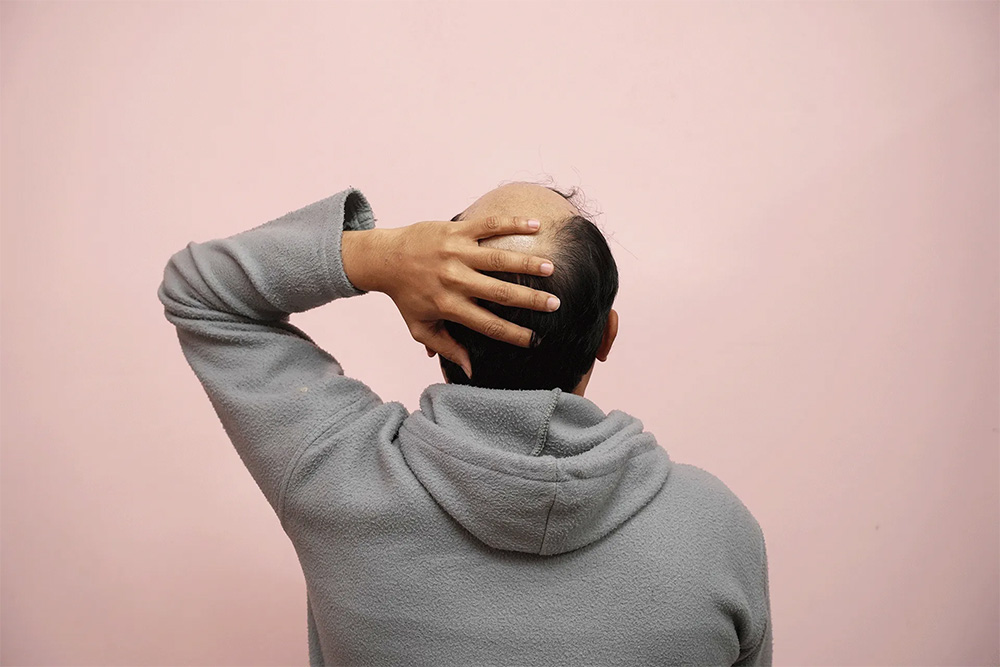 Everything You Need To Know About Alopecia