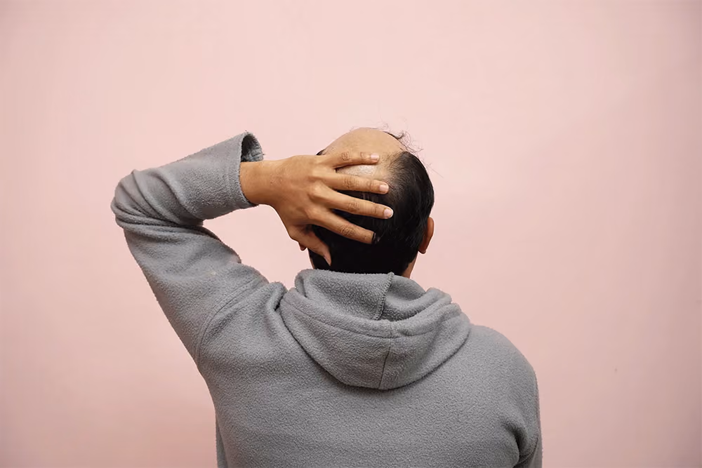 Everything You Need To Know About Alopecia