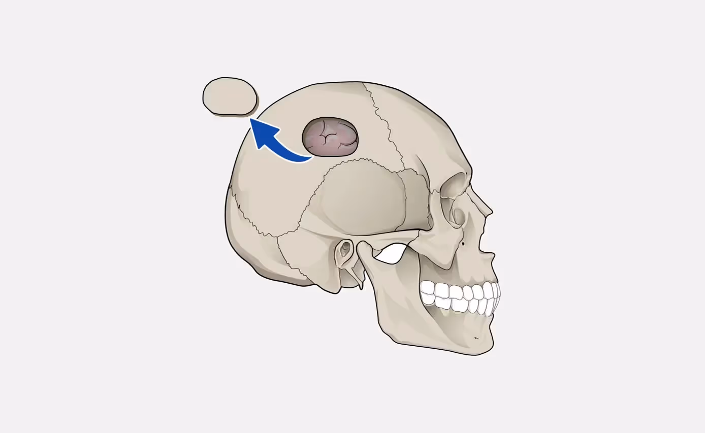 Persistent Headache was Due to Brain Tumor in a Young Filipino