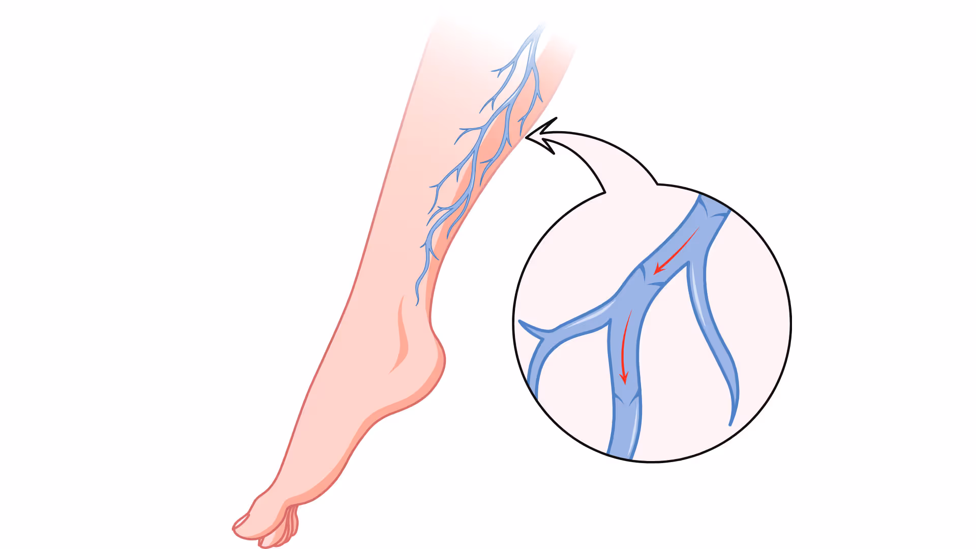 Varicose Veins Treatment Dubai
