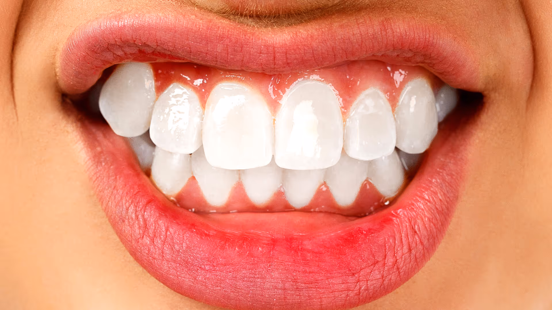 Teeth Grinding in Children