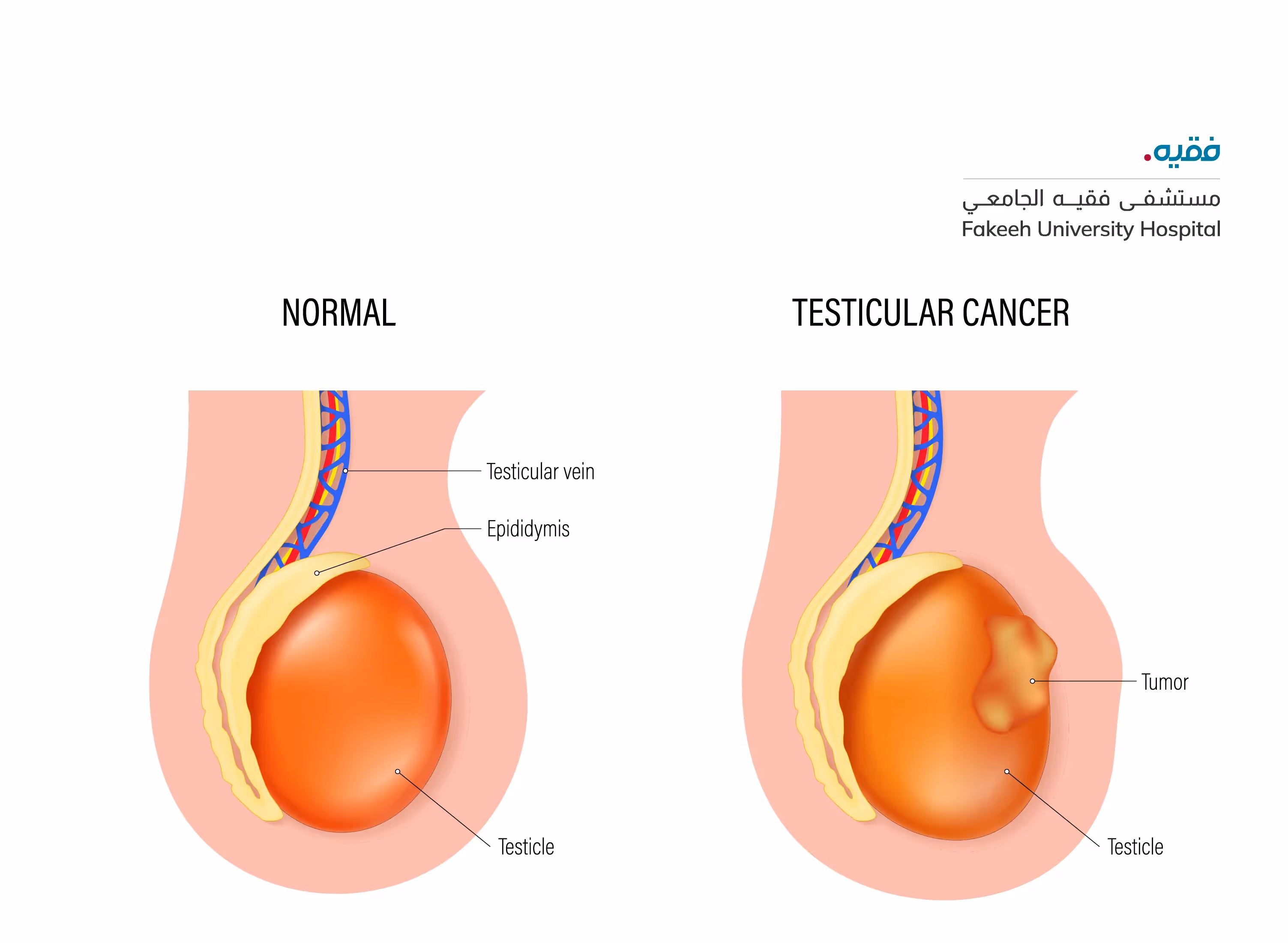  Testicular cancer is not a common cancer but it is the second most common cancer in young men (aged 20 to 39) excluding non-melanoma skin cancer. 