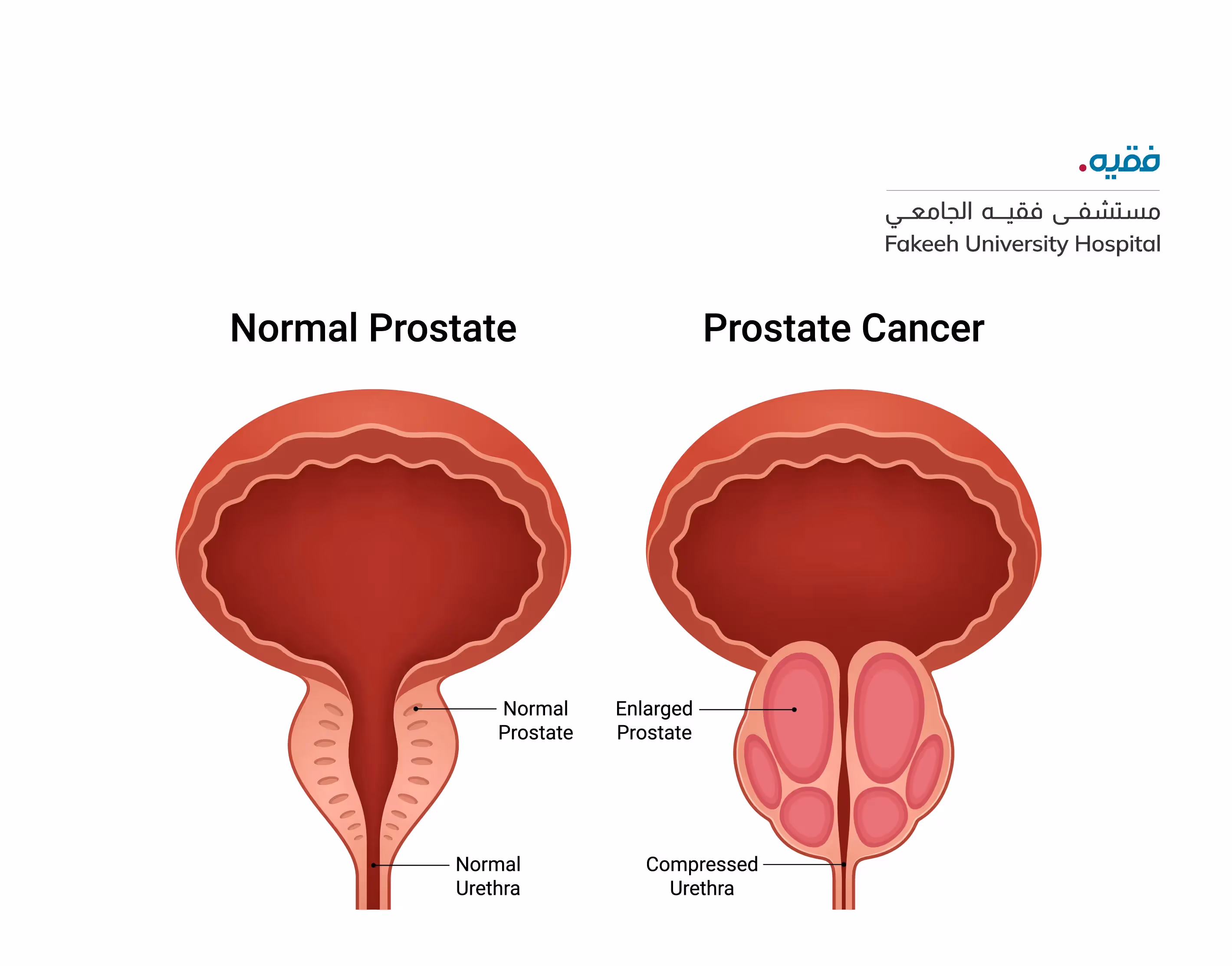 A diagram explaining normal prostate and prostate cancer for male