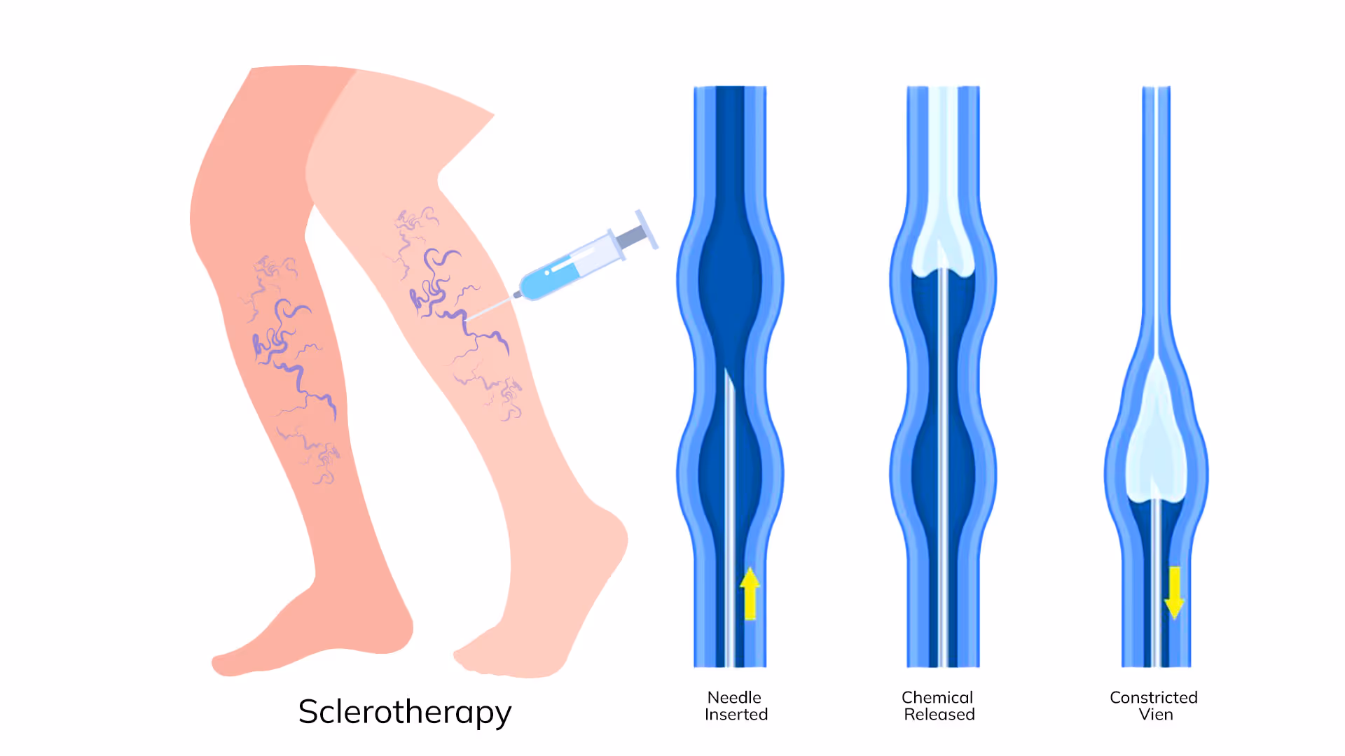 Sclerotherapy for Varicose Veins