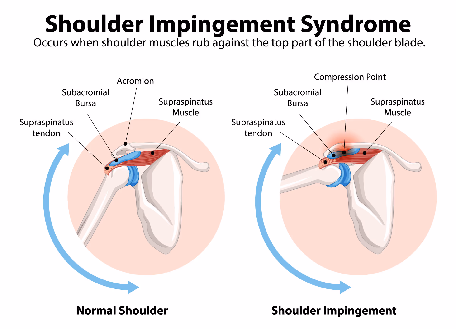 Shoulder Impingement Syndrome and Shoulder Pain Treatment 