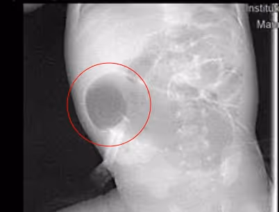 X-Ray picture of the 2 days old baby who undergoes complex gastrointestinal surgery at fakeeh university hospital
