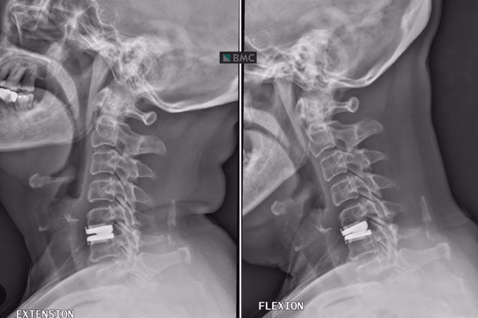 Father gets back to enjoying life with his kids, pain free after complex spine surgery
