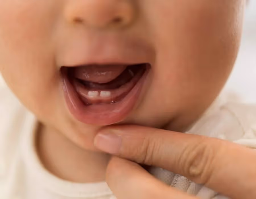 A Rare Smile: Managing Neonatal Teeth
