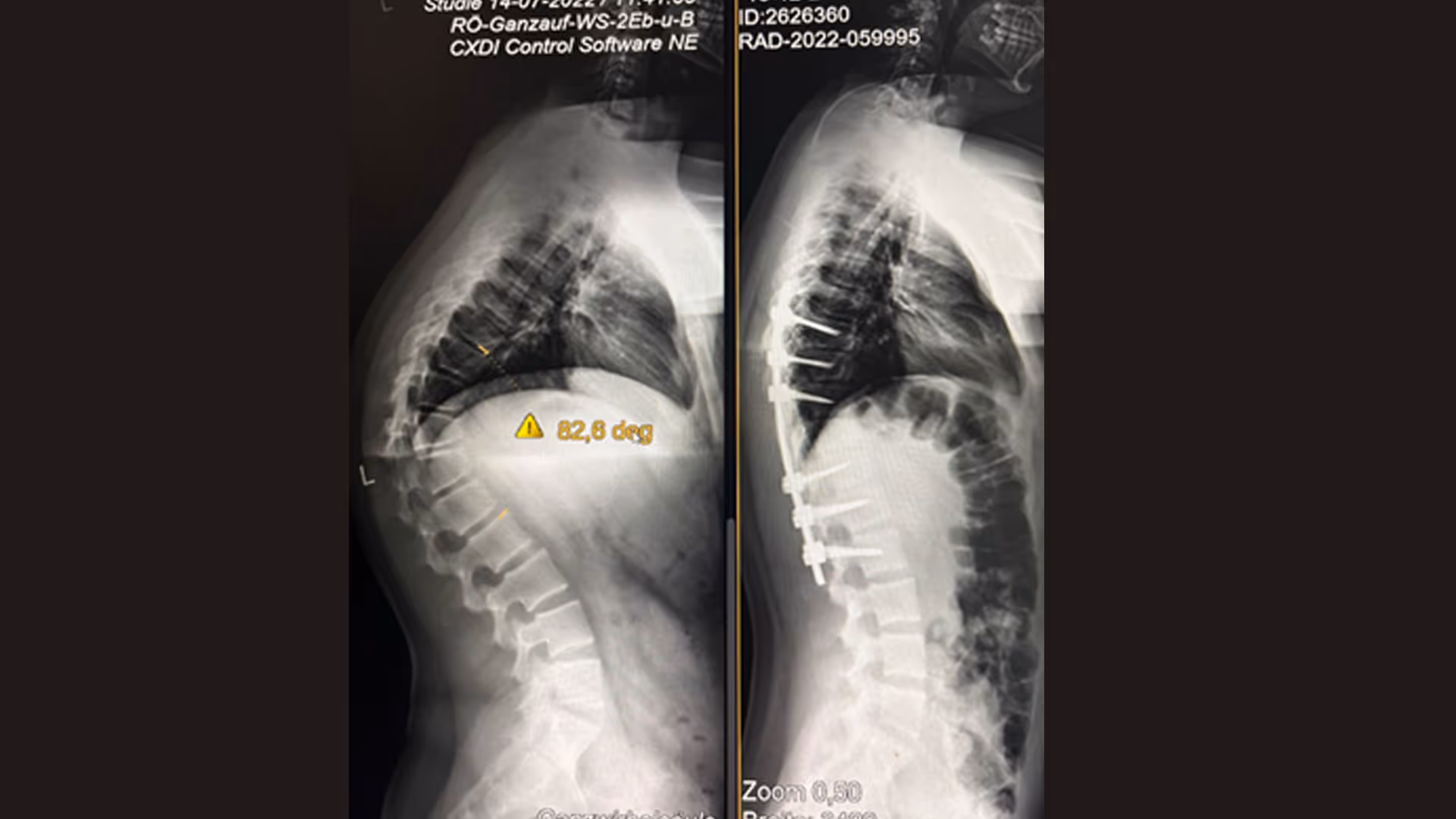  Kyphosis in Children - 15 years old boy had severe thoracic Kyphosis 82° 