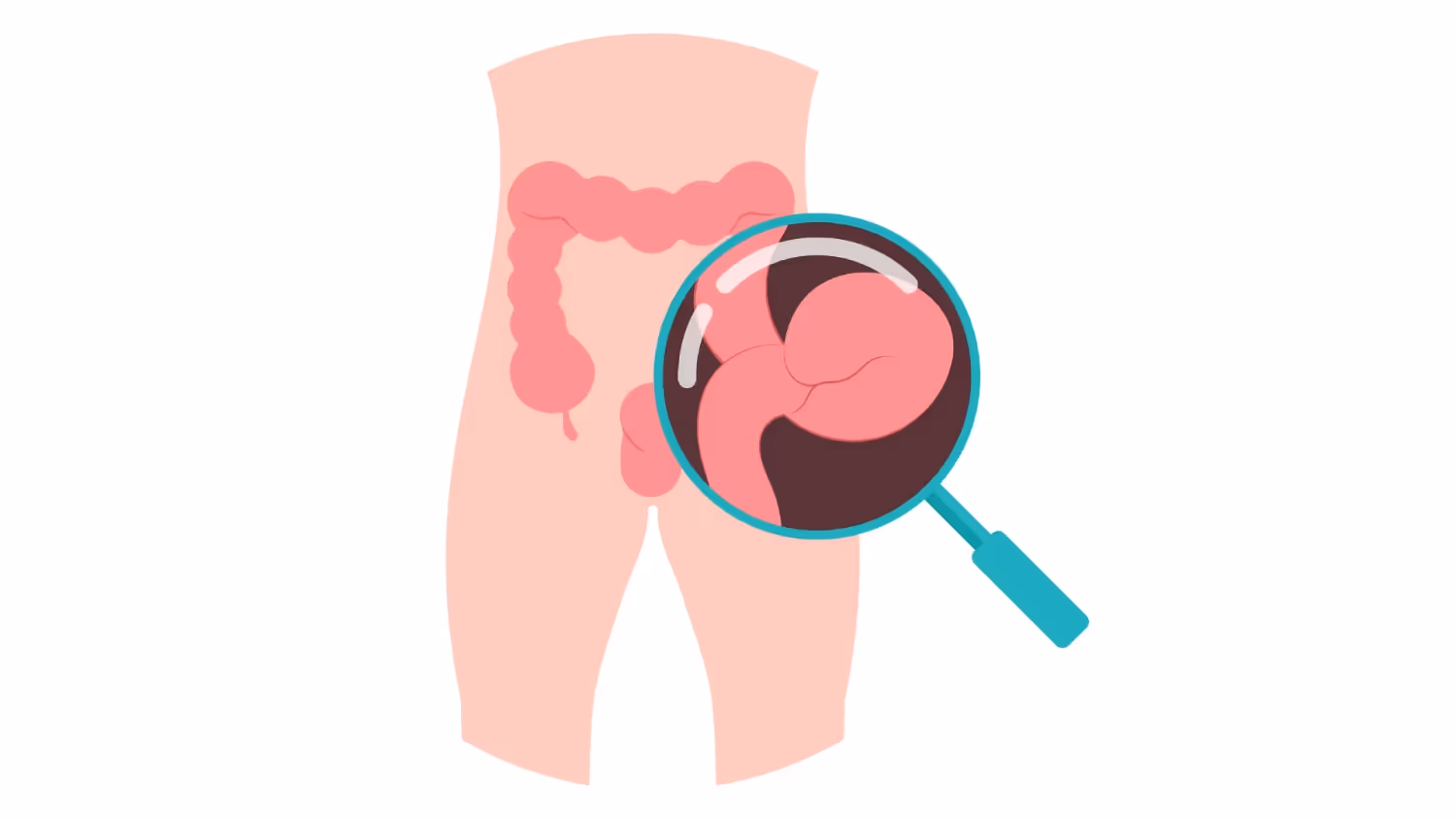 What is a Hernia?