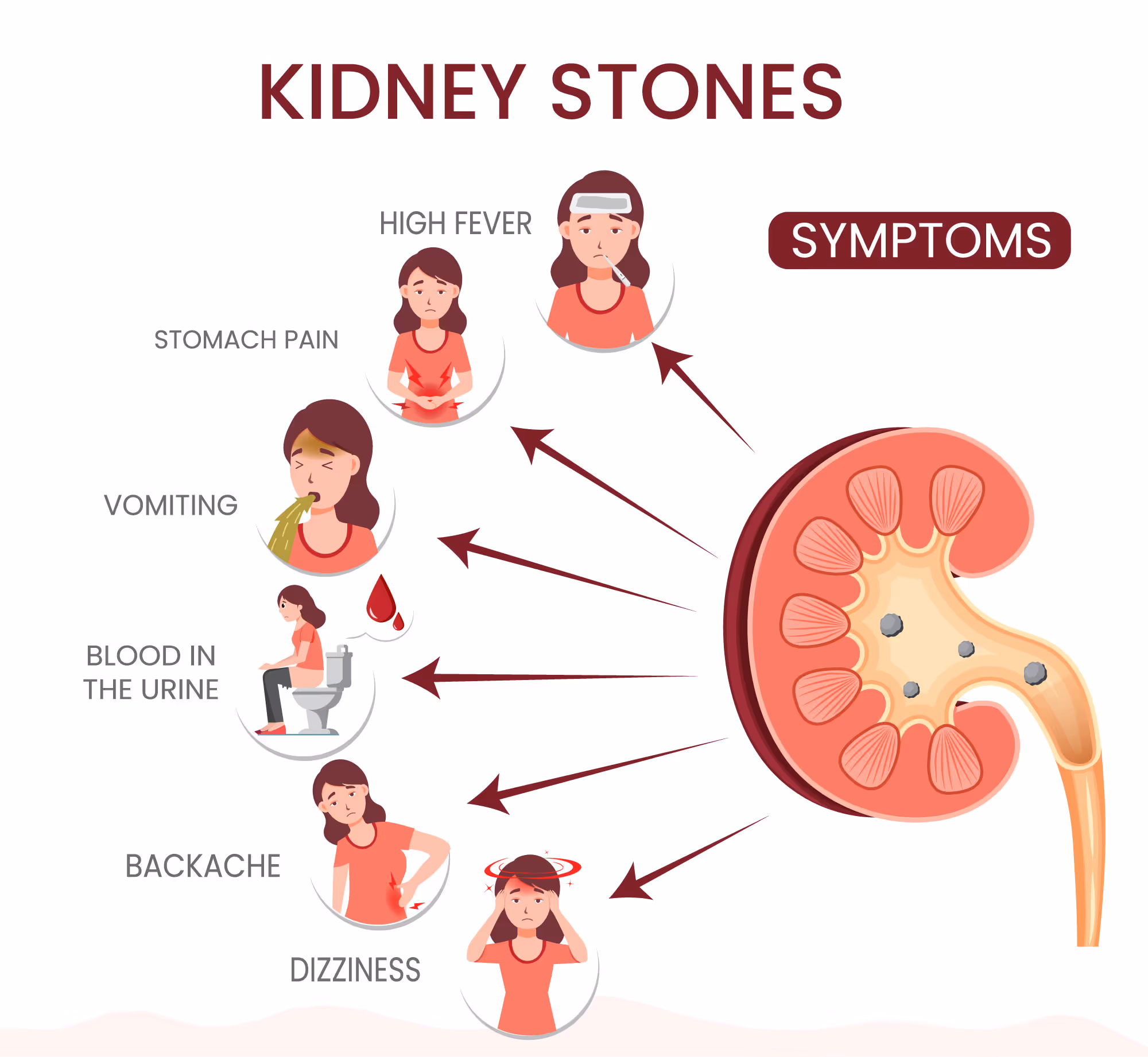 What Are the Key Symptoms of Kidney Stones?