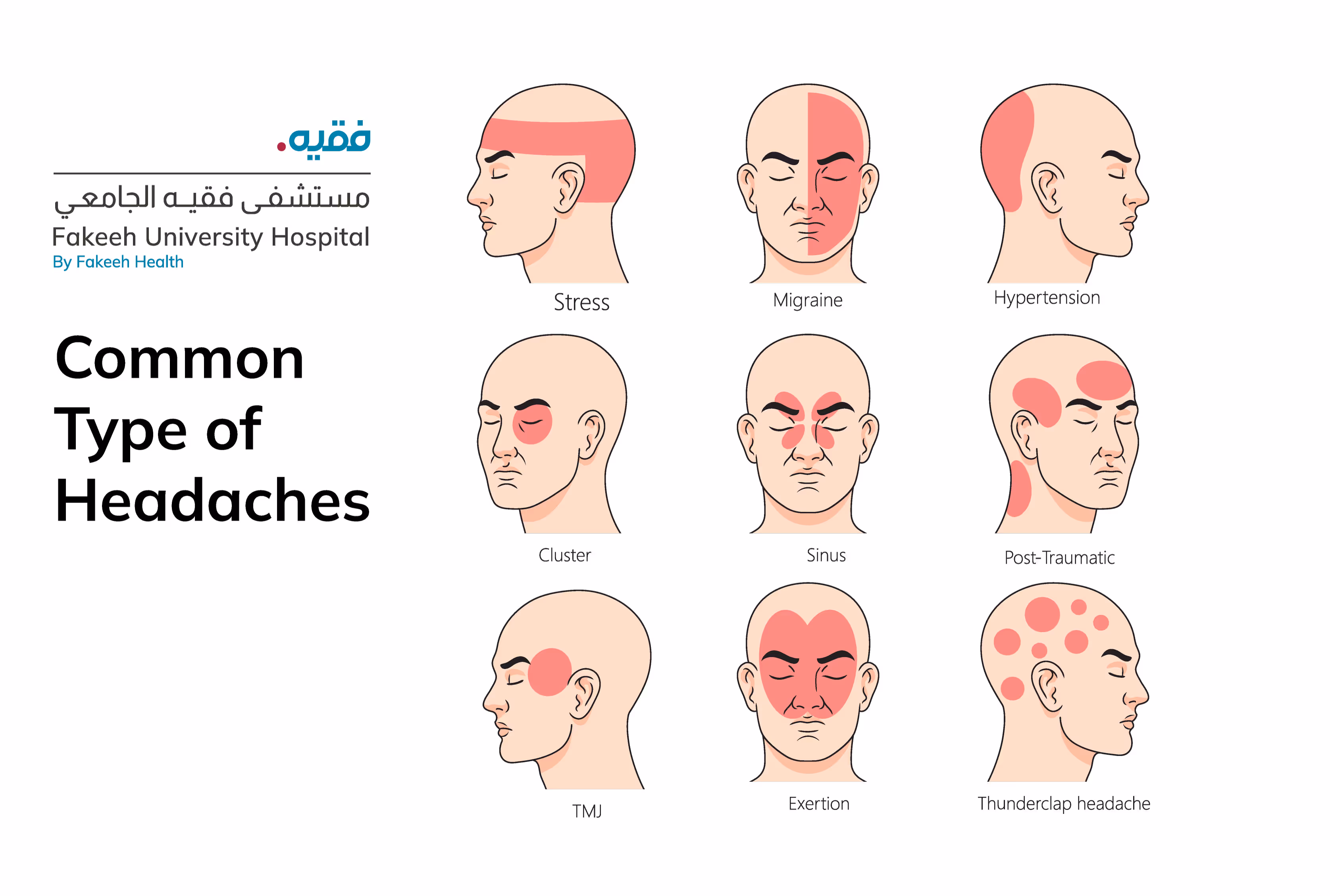 Common Types of Headaches and Their Symptoms