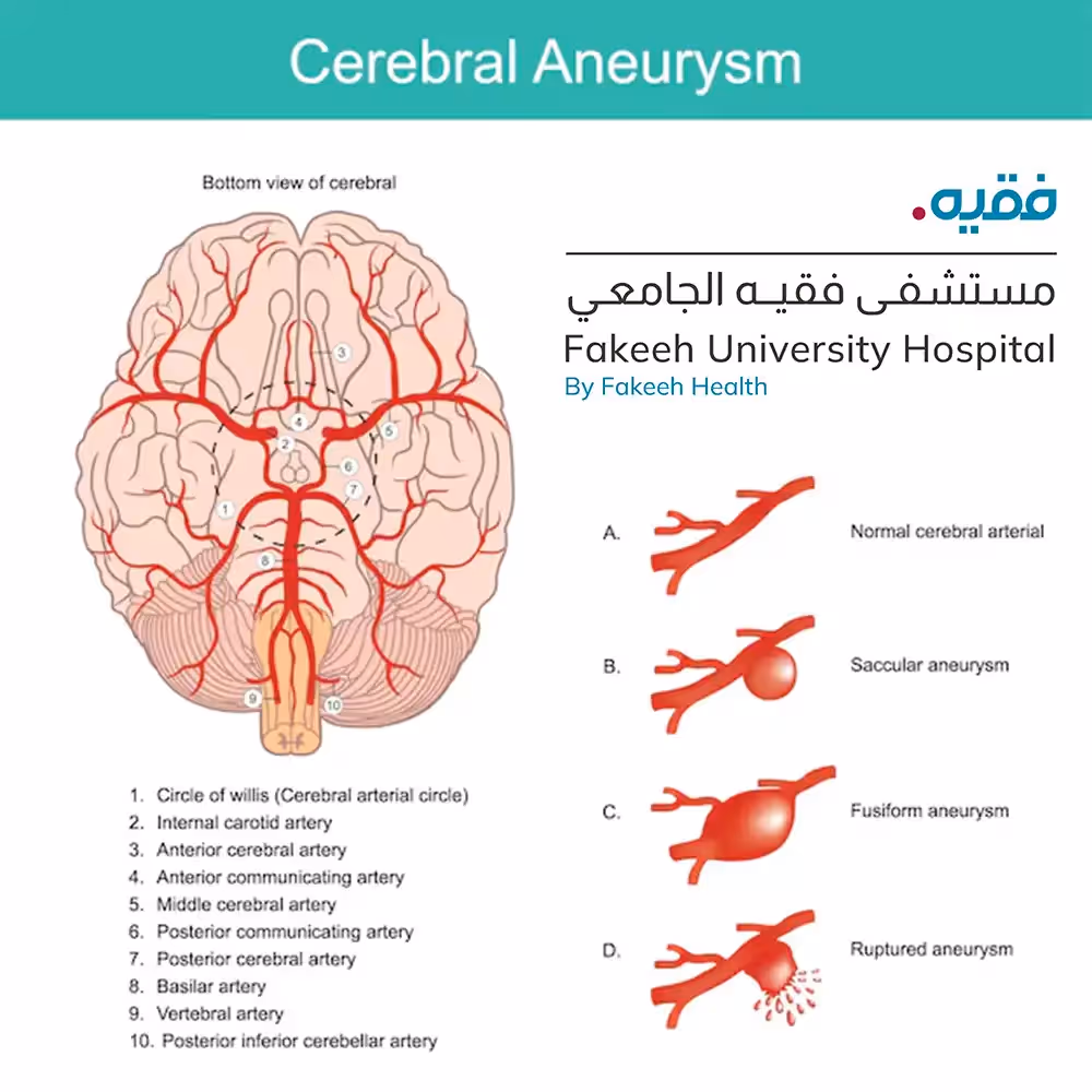A cerebral aneurysm, also known as a brain aneurysm or intracranial aneurysm, is a bulge in a weak spot in the wall of a blood vessel in the brain.