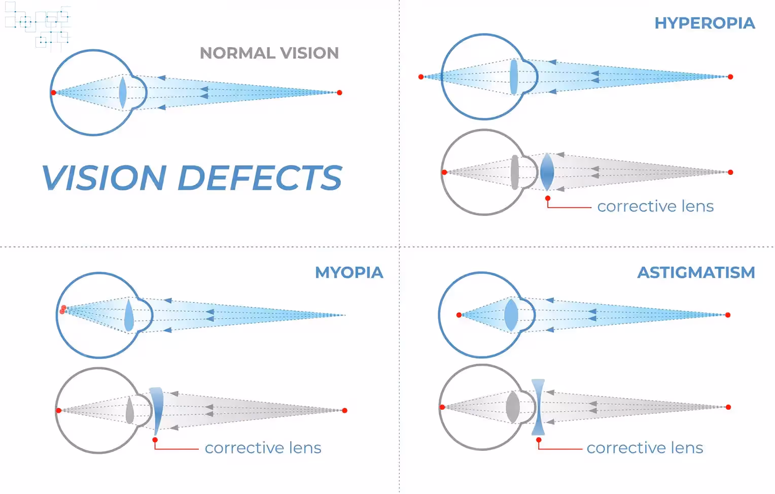 Astigmatism is diagnosed through a comprehensive eye examination