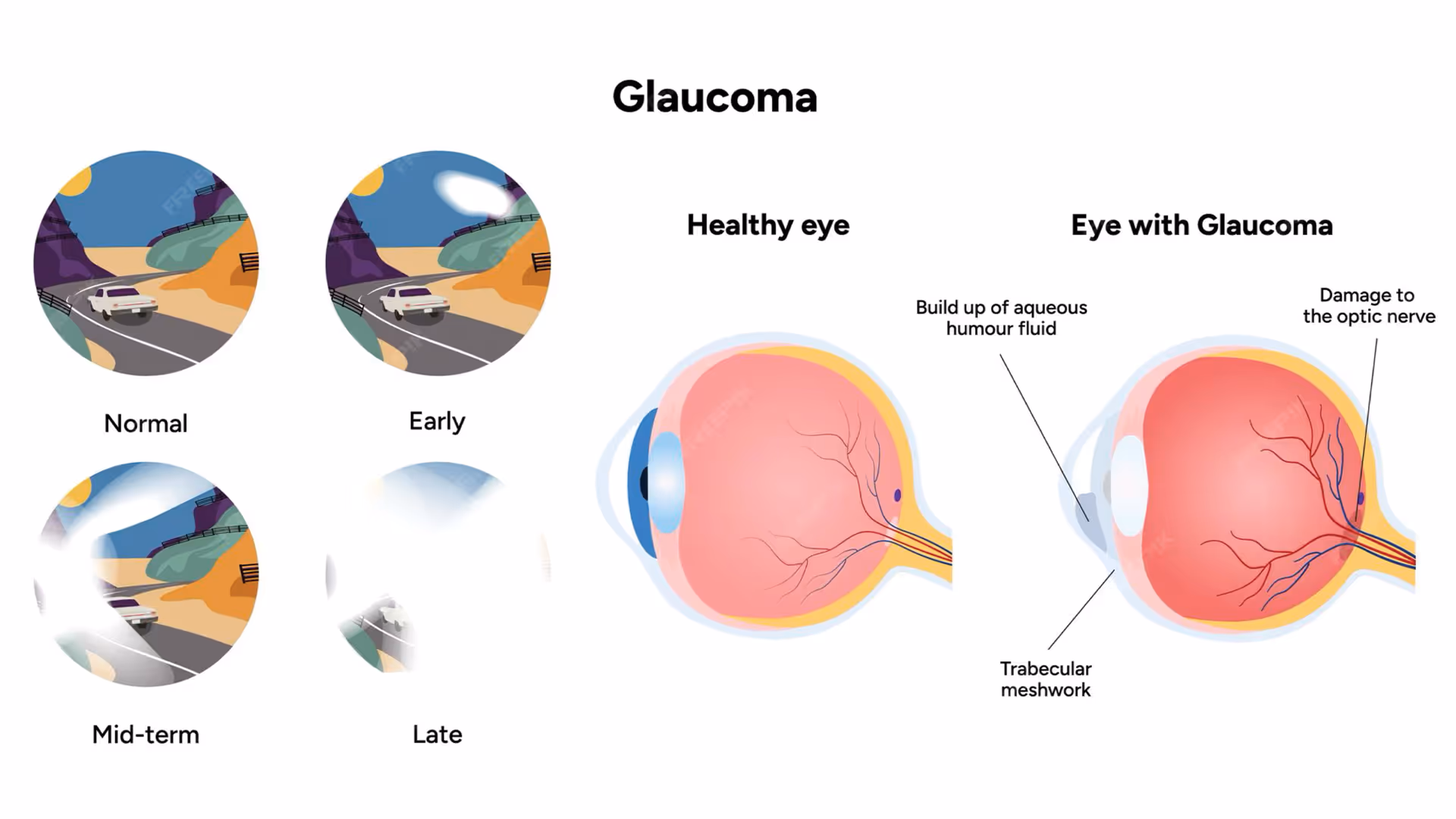 a picture of healthy eye and an eye with Glaucoma