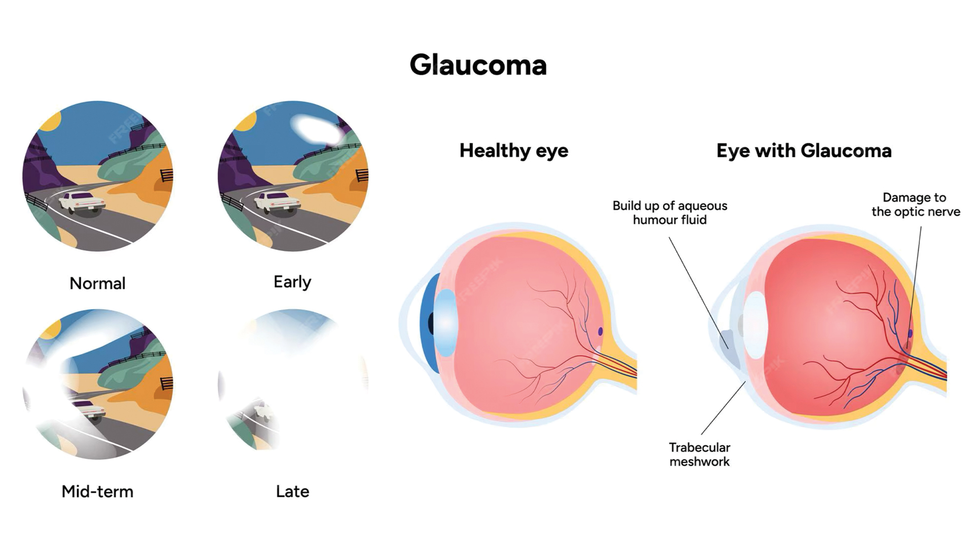 a picture of healthy eye and an eye with Glaucoma
