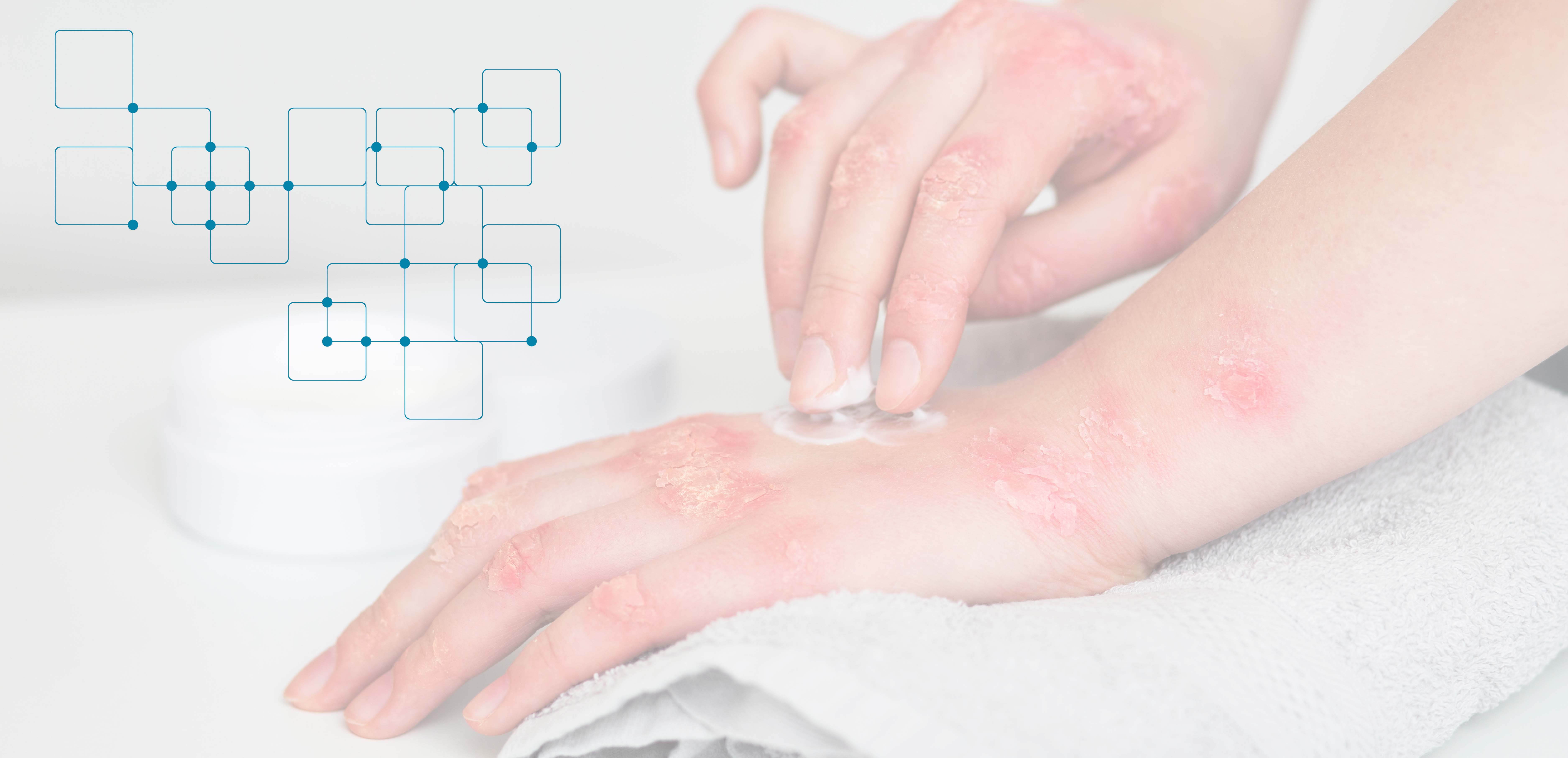 Eczema treatment Dubai