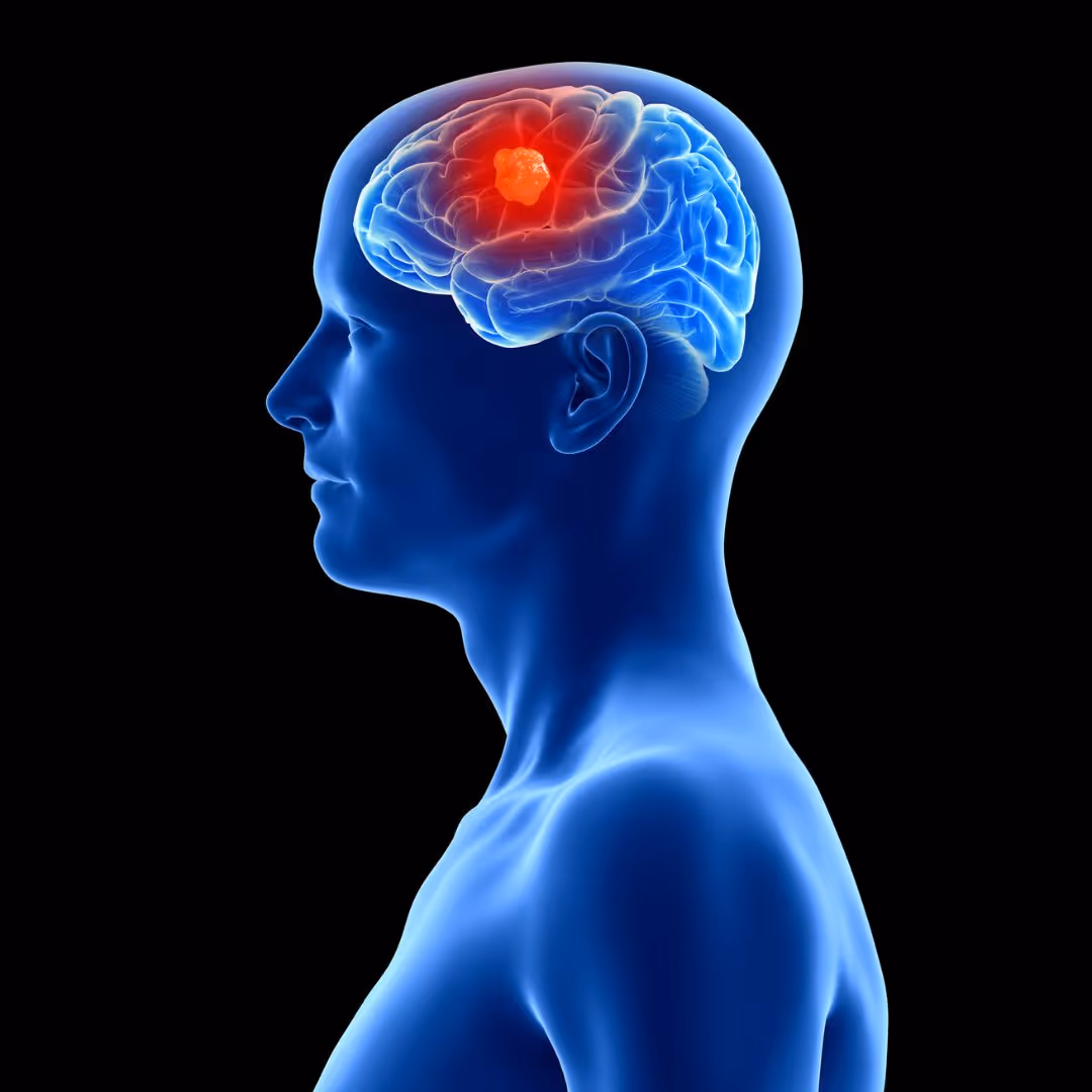 Stroke Education