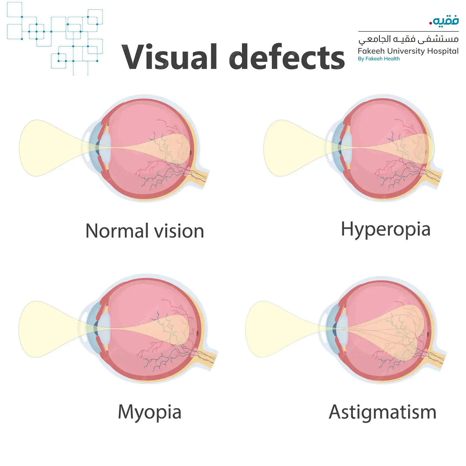 Astigmatism is diagnosed through a comprehensive eye examination