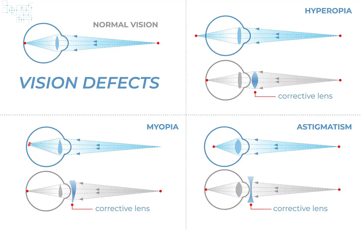 Astigmatism is diagnosed through a comprehensive eye examination