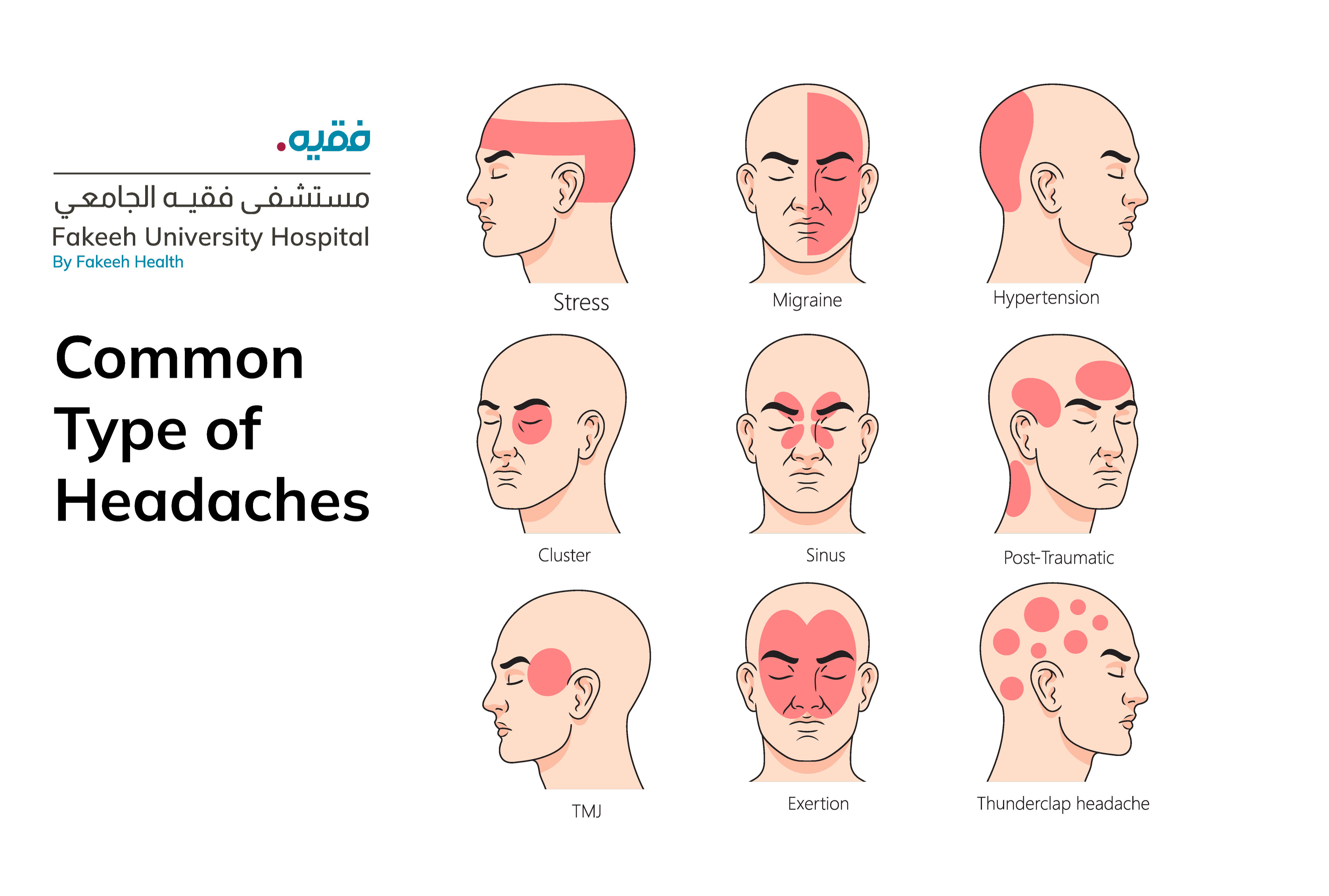 Common Types of Headaches and Their Symptoms