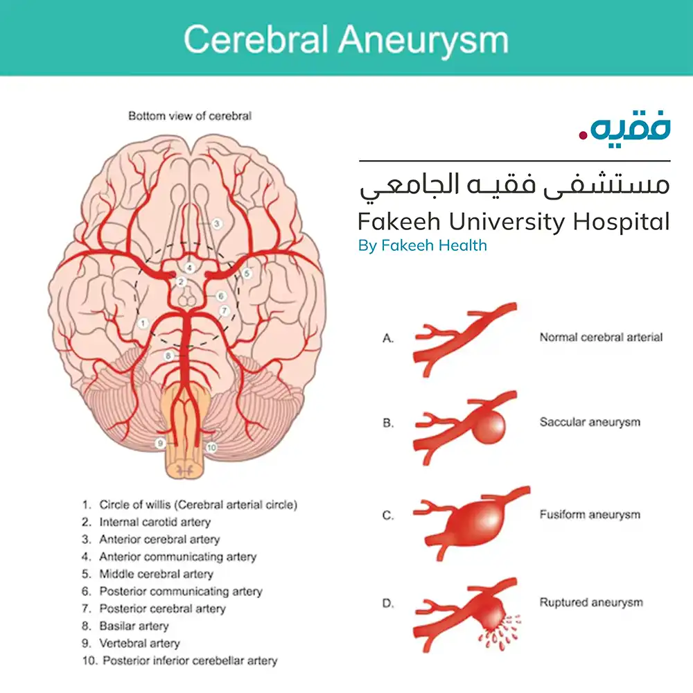 A cerebral aneurysm, also known as a brain aneurysm or intracranial aneurysm, is a bulge in a weak spot in the wall of a blood vessel in the brain.