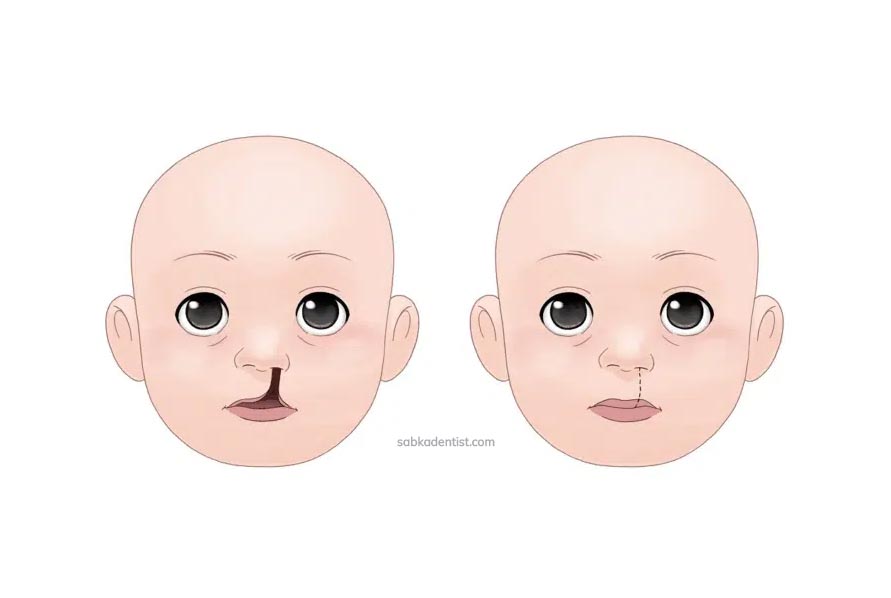 طفل بعمر 3 أشهر يستعيد ابتسامته بعد جراحة تصحيحية للشفة المشقوقة (الشفة الأرنبية)