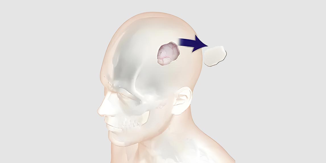 احتفال مريض يبلغ من العمر 61 عاماً بعيد ميلاده في مستشفى فقيه الجامعي بعد إجراء جراحة ورم المخ