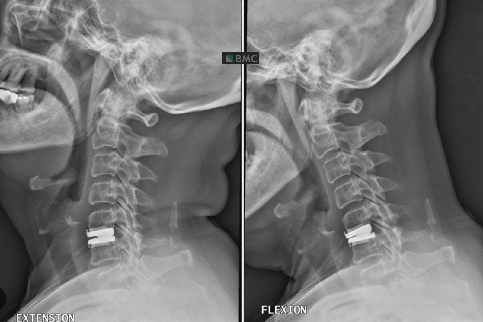 أب يستعيد نمط حياته مرةً أخرى ويستمتع مع أطفاله دون الشعور بالألم بعد خضوعه لجراحة معقدة في العمود الفقري