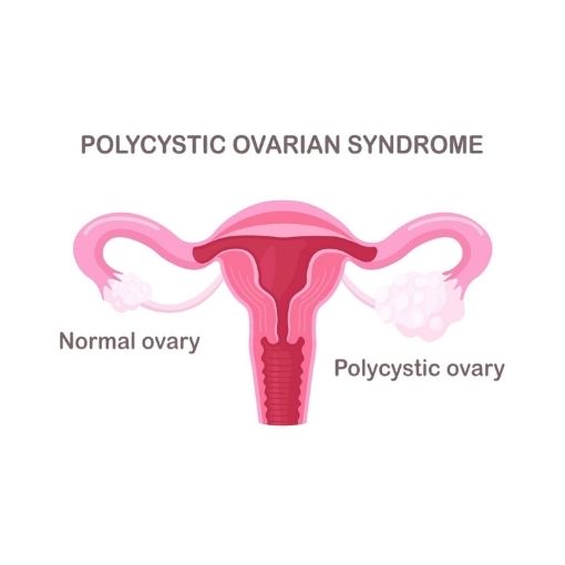 What is Polycystic Ovary Syndrome or PCOS?