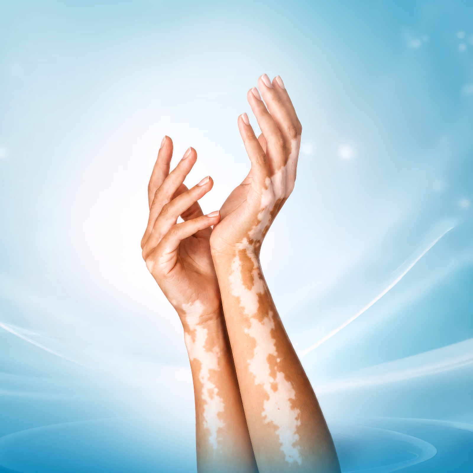 Narrow Band Phototherapy