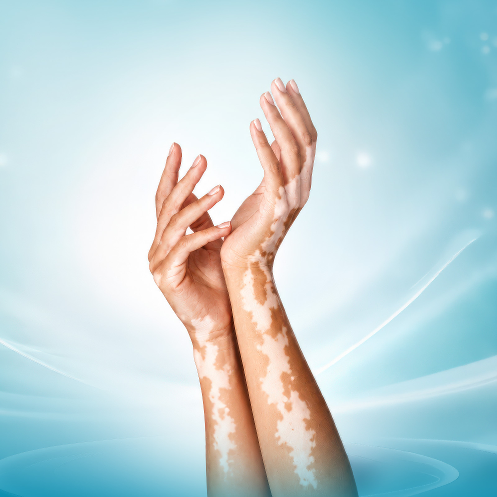 Narrow Band Phototherapy
